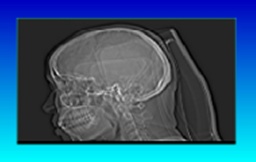 DICOM images stored on an MO disk that had been used in a CT scanner. 
